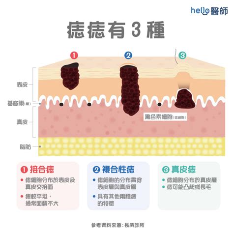 臉上長很長的毛|痣形成的原因？痣長毛、痣變多變大是痣病變？5招判別